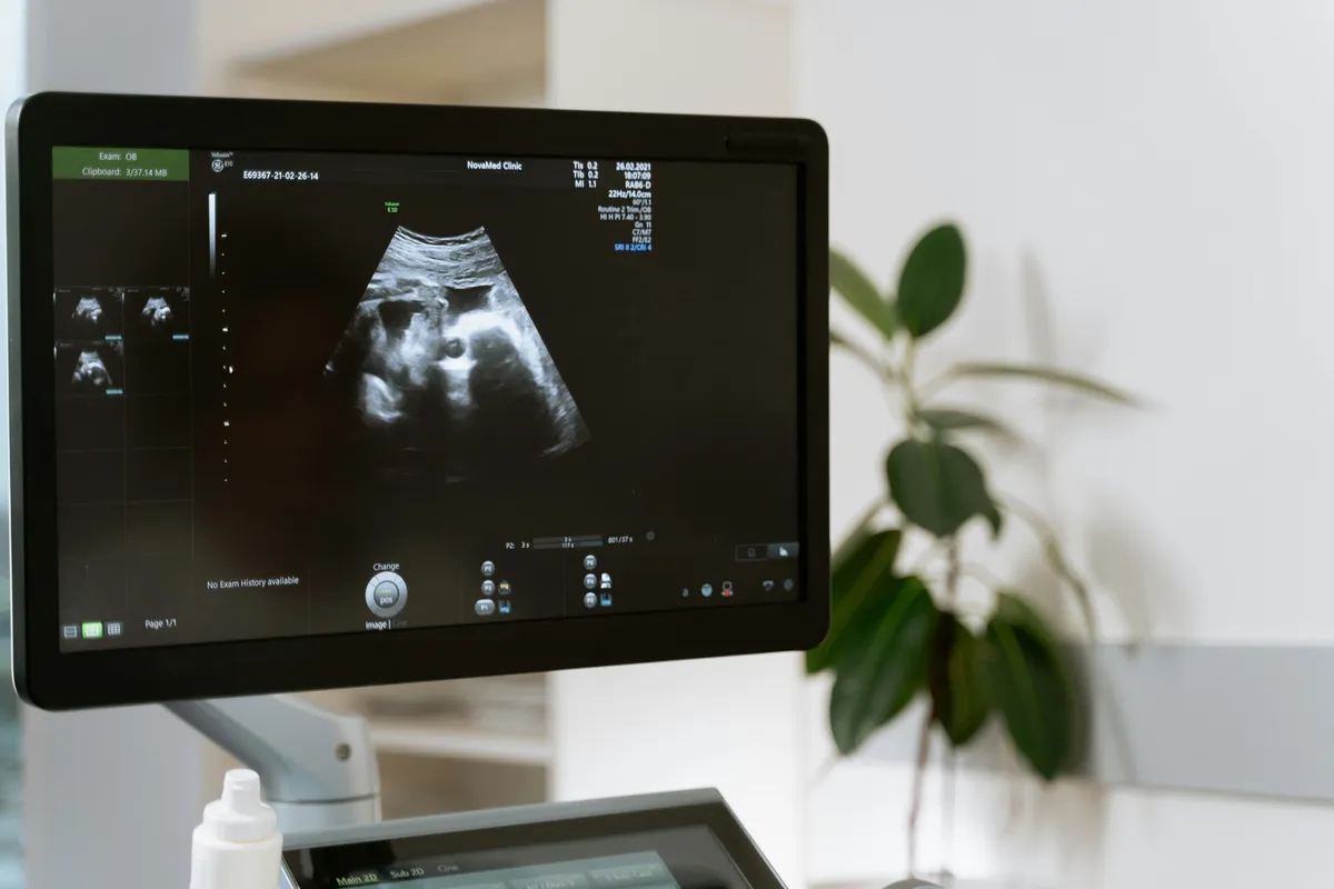 An ultrasound screen showing a 3D image of a baby